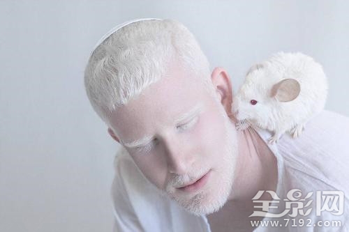 摄影师为白化病人拍唯美大片视频 白化病人拍的照片